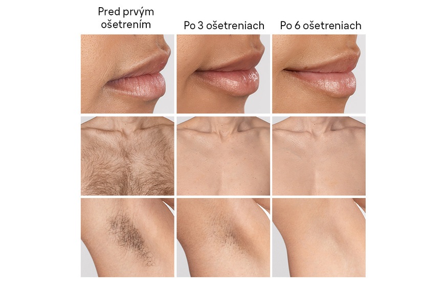 Ako správne používať IPL epilátor Braun a dosiahnuť dlhodobo hladkú pokožku? Sovnanie pred prvým ošetrením, po 3 ošetreniach a po 6 ošetreniach.